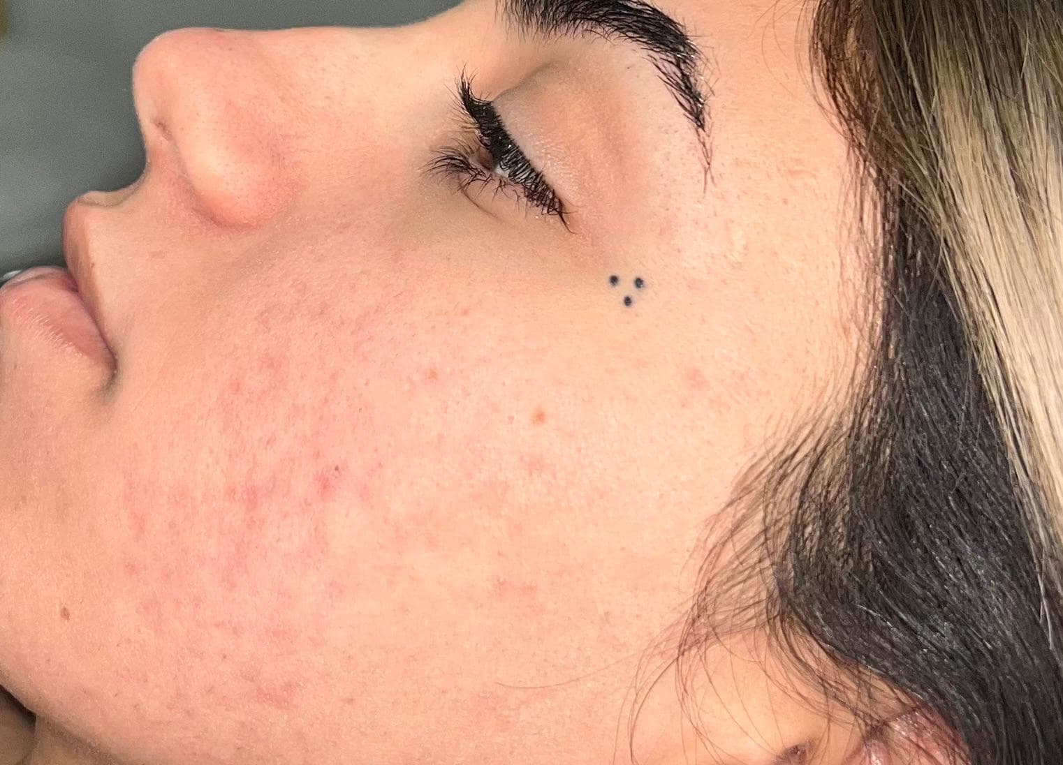 قبل - حب الشباب