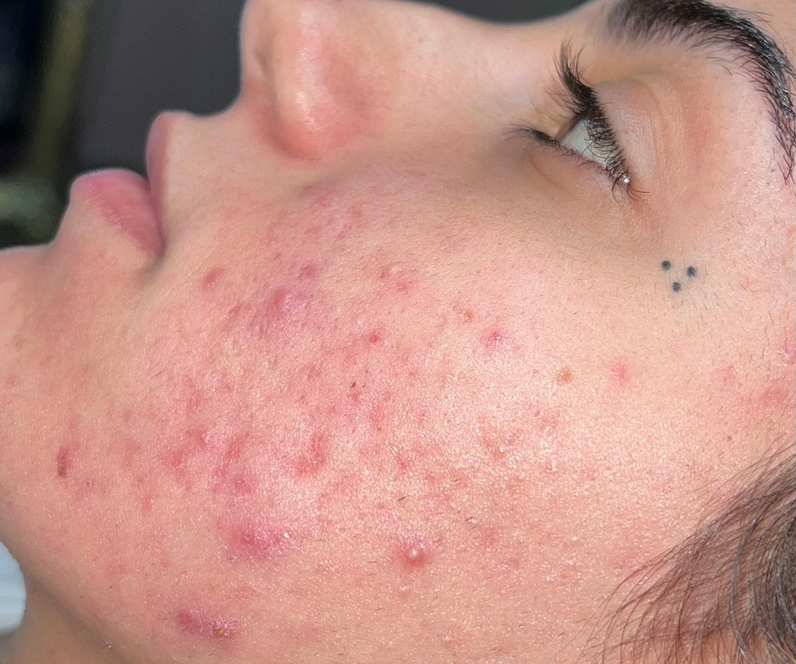 بعد - حب الشباب