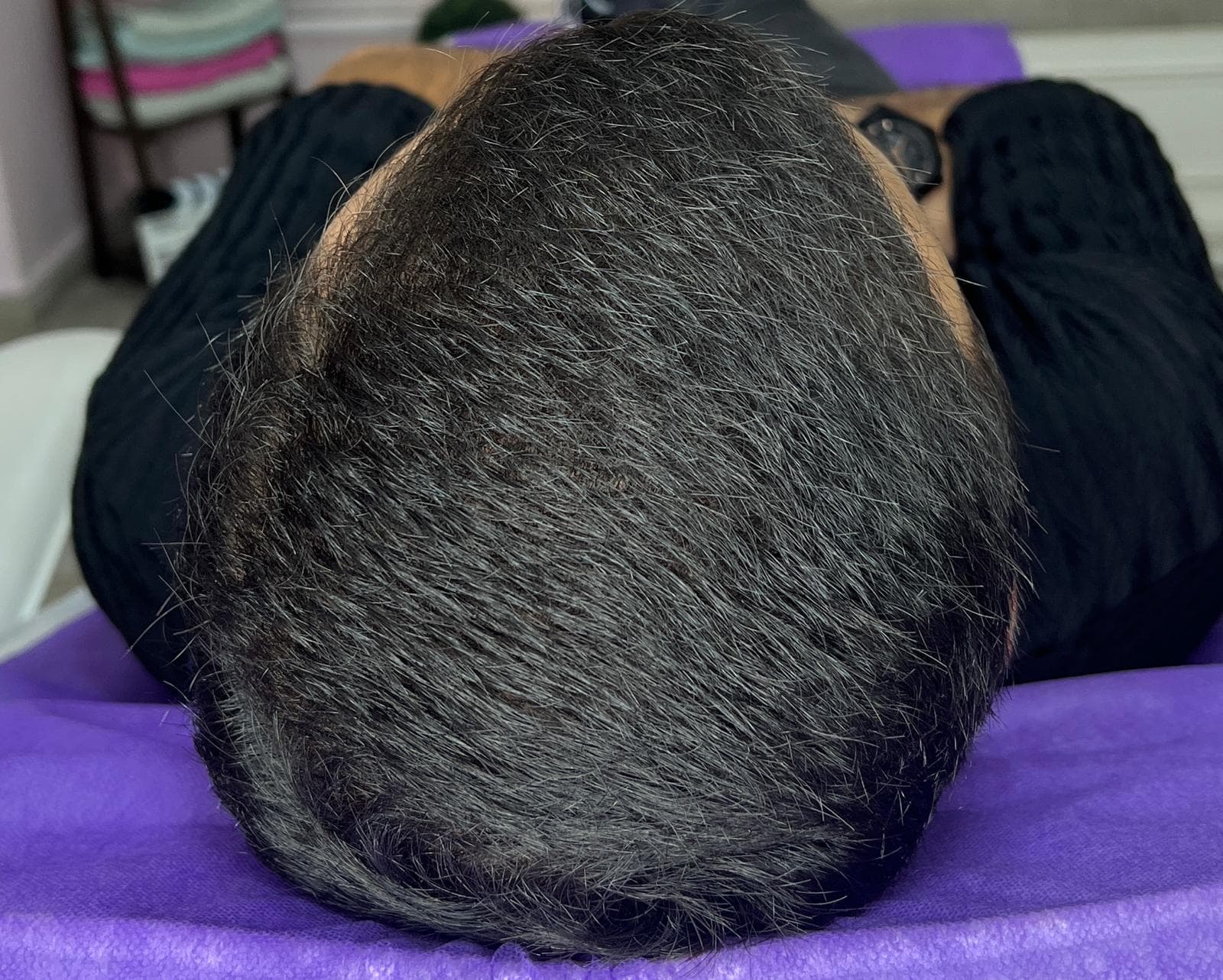 قبل - تساقط الشعر