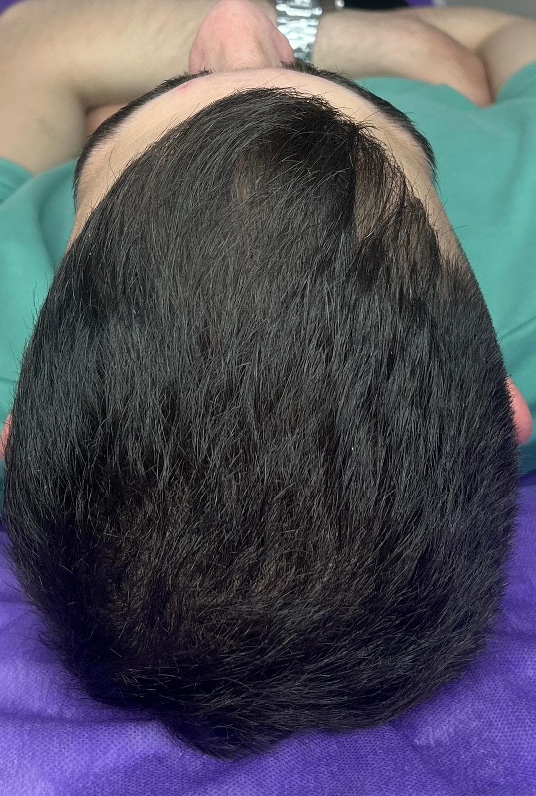 قبل - تحفيز نمو الشعر