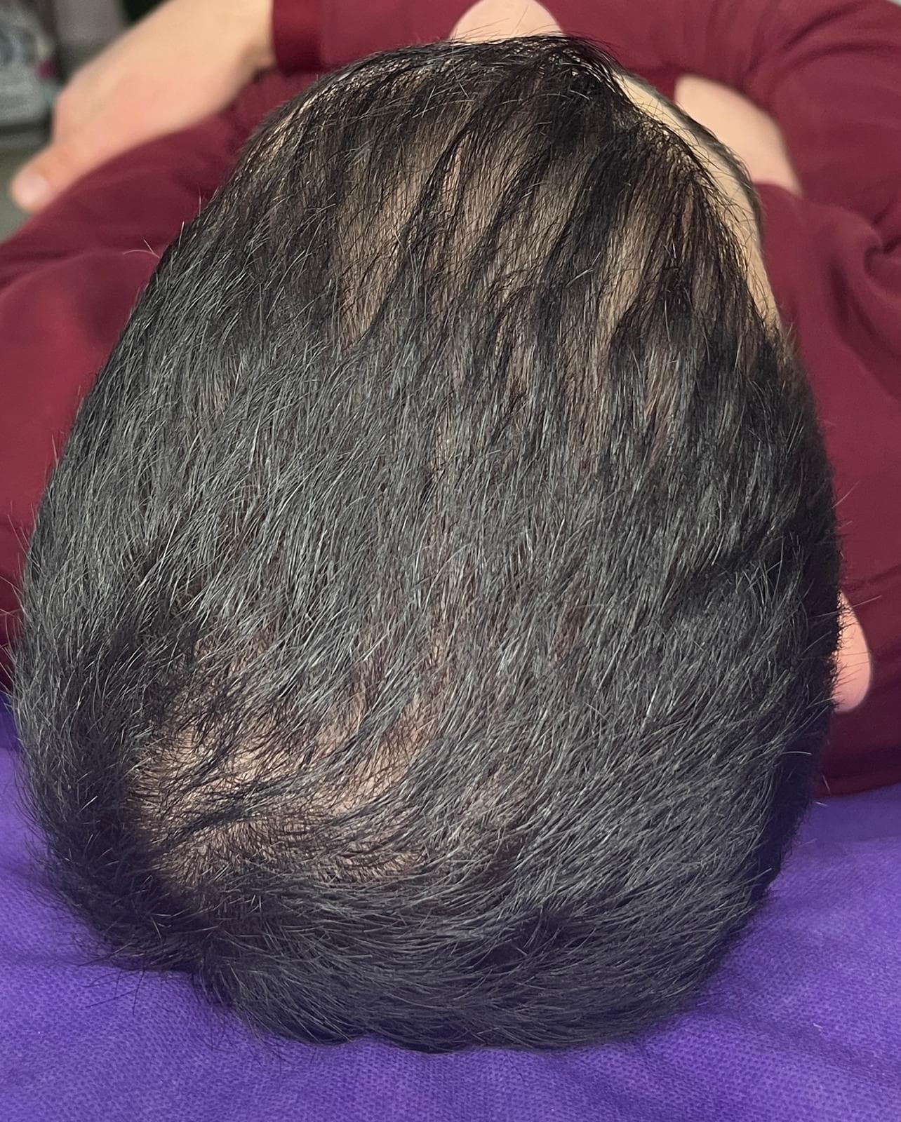 بعد - تحفيز نمو الشعر