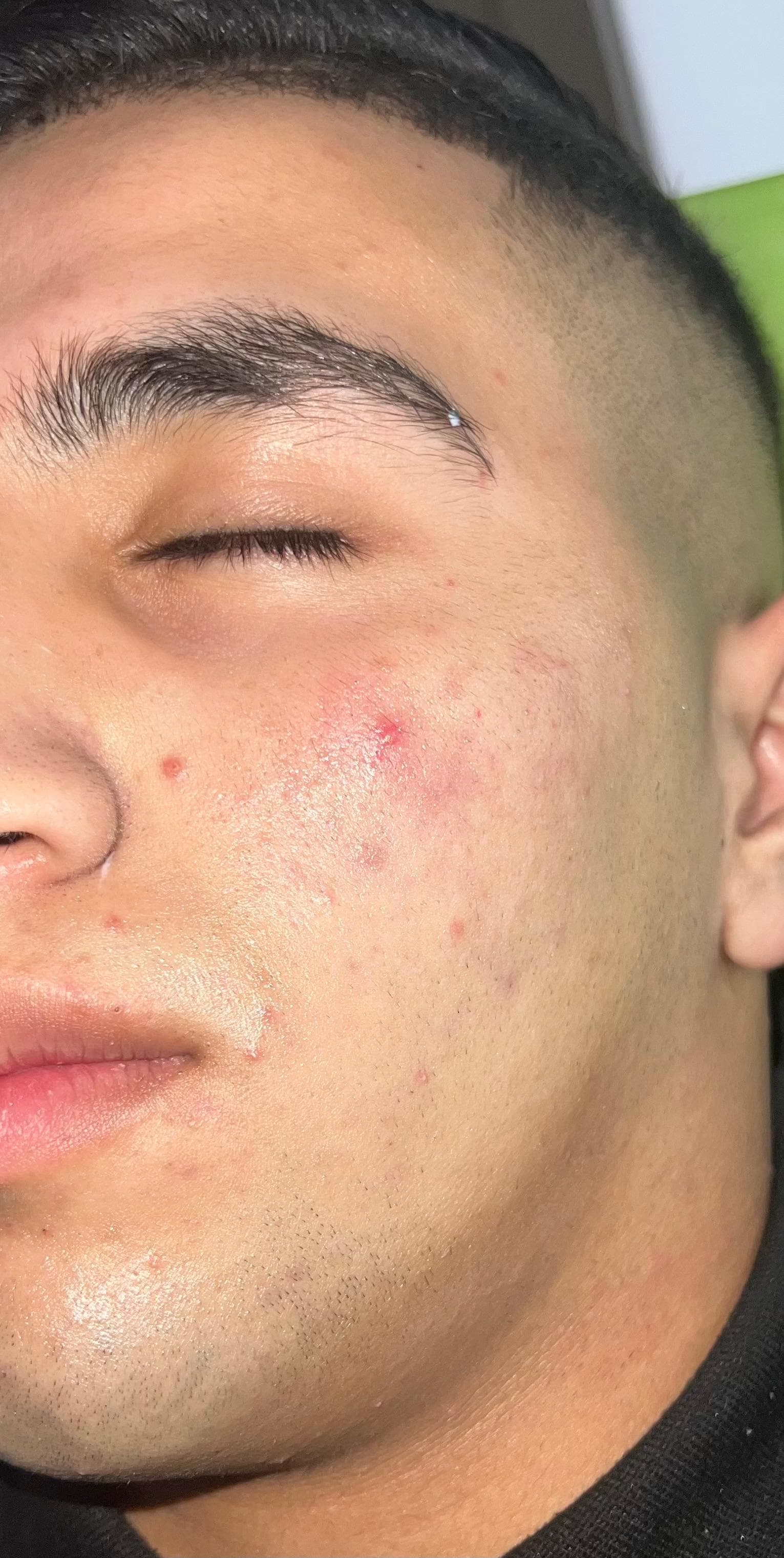 قبل - تصفية البشرة